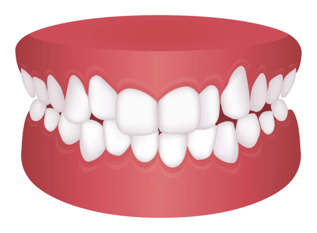 teeth crowding